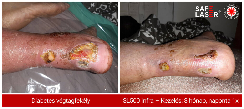 Diabetesfekelylabsl500kep1 2 tiny