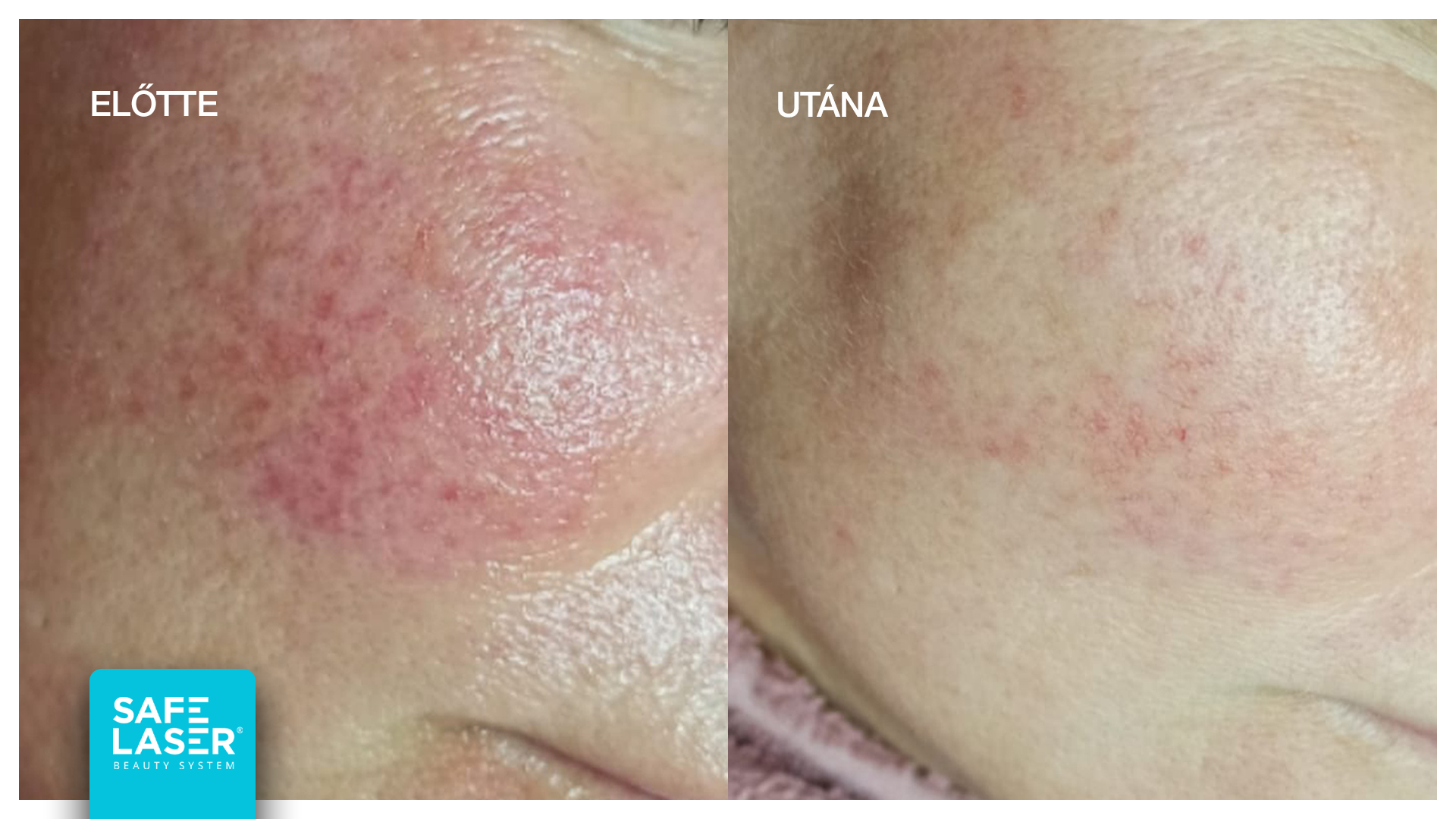 sl rosacea